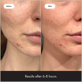 Cosmetics Mighty Patch Invisible+ Daytime Hydrocolloid Acne Pimple Patches